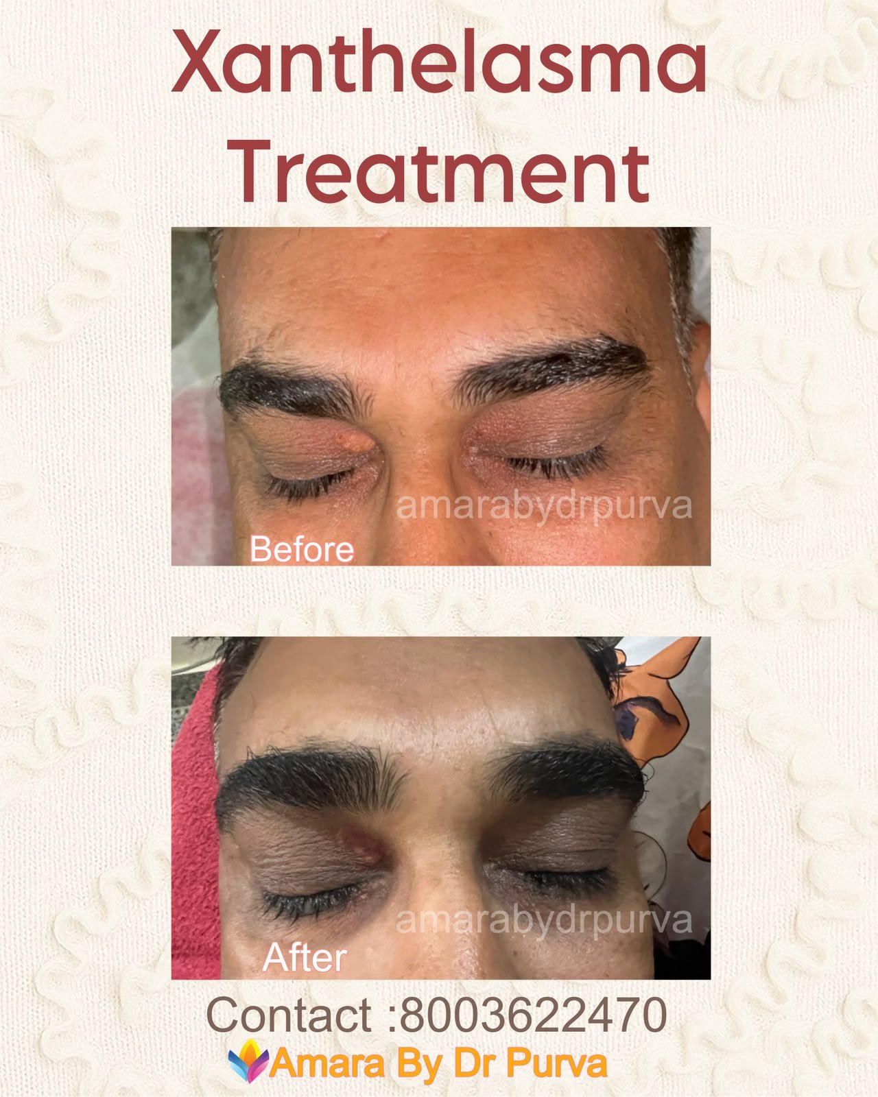 Xanthelasma treatment before and after at Amara